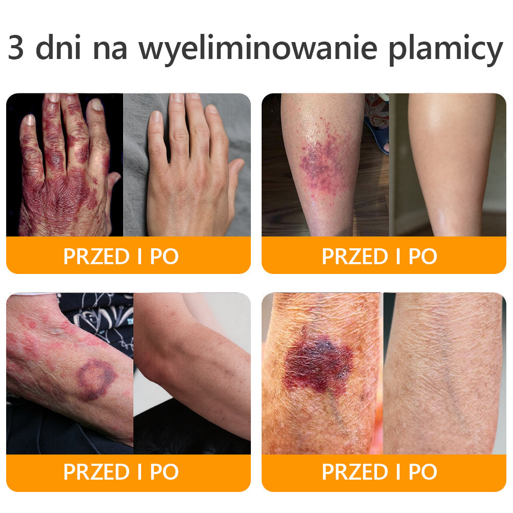 ΑPΚΑPK™ Jad Pszczoły Kompleksowy Krem🥇pomaga w leczeniu problemów skórnych, takich jak: zmarszczki, blizny, plamy pigmentacyjne, rozstępy, trądzik, łuszczyca, egzema, zmiany skórne, podrażnienia, stany zapalne i inne problemy skórne🔥